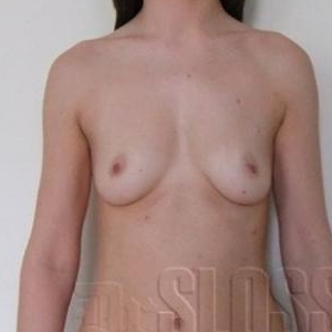 Увеличение груди имплантами МакГан LX объёмом 290 мл