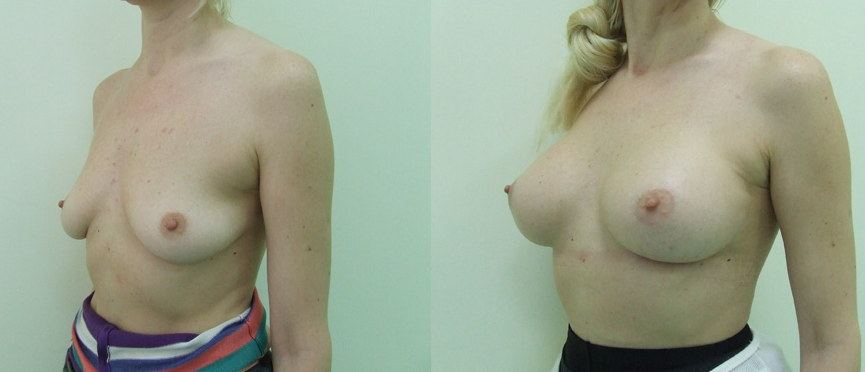 Увеличение груди