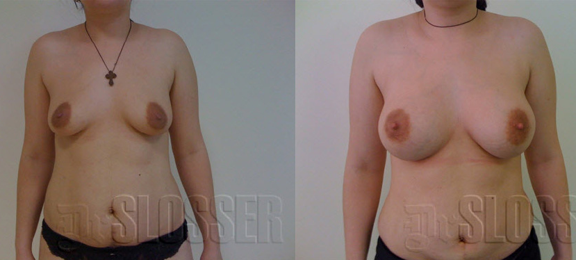 Увеличение груди