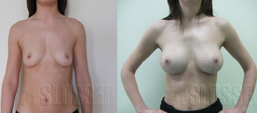 Увеличение груди