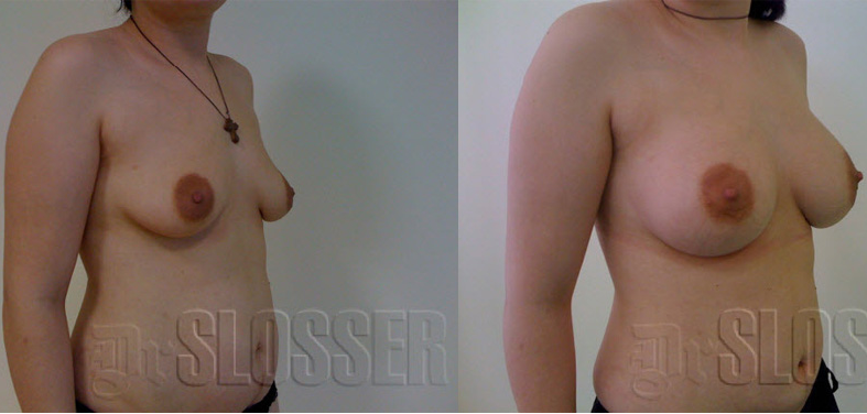 Увеличение груди