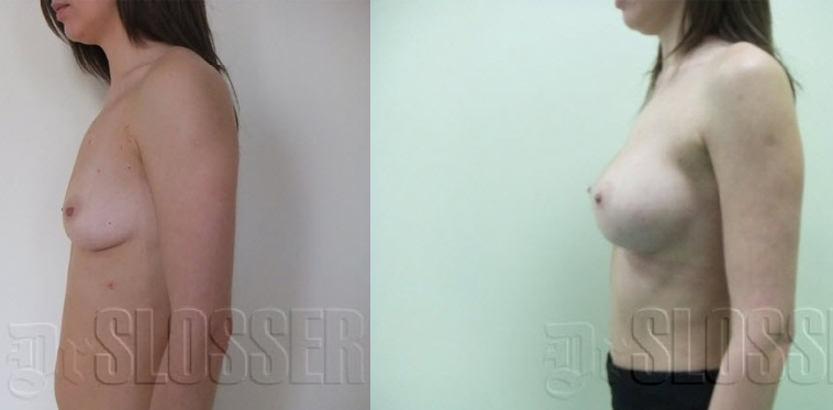 Увеличение груди